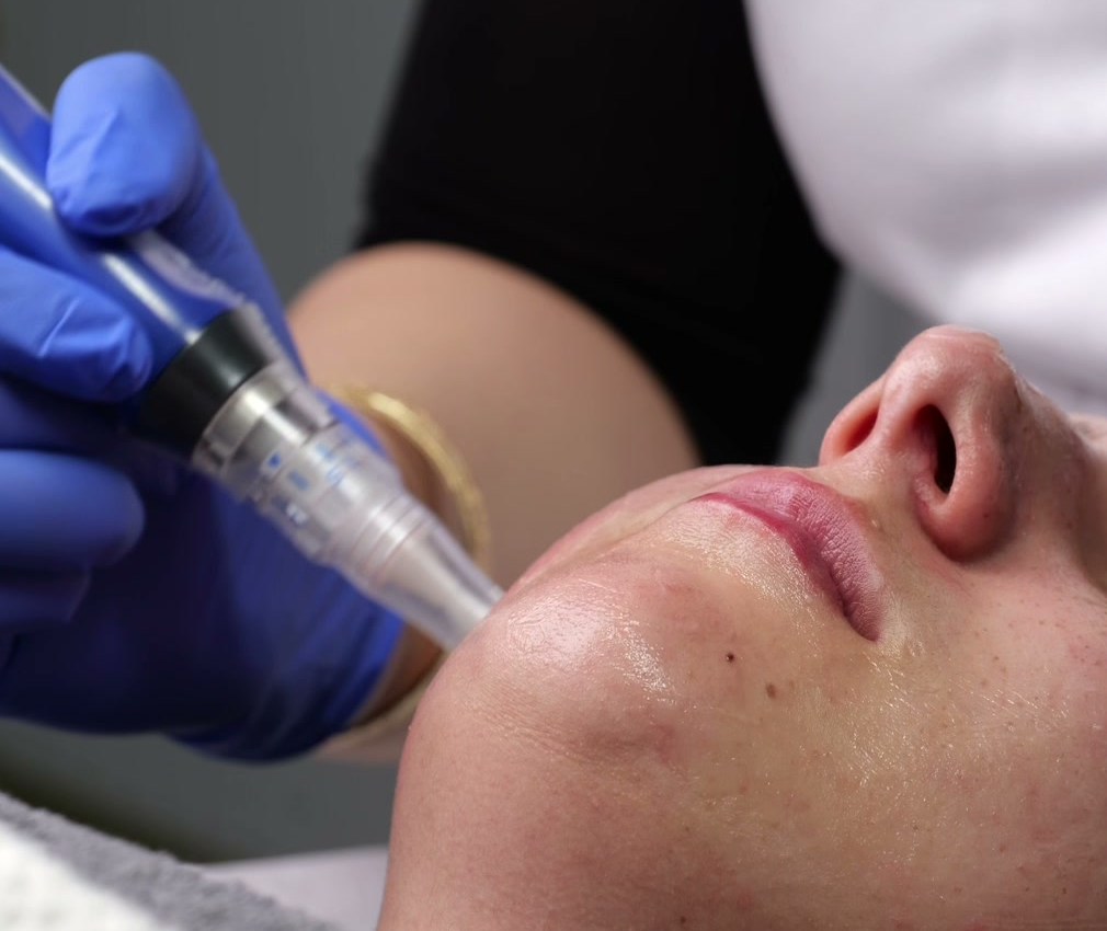 Behandling med Skinpen vid hakan